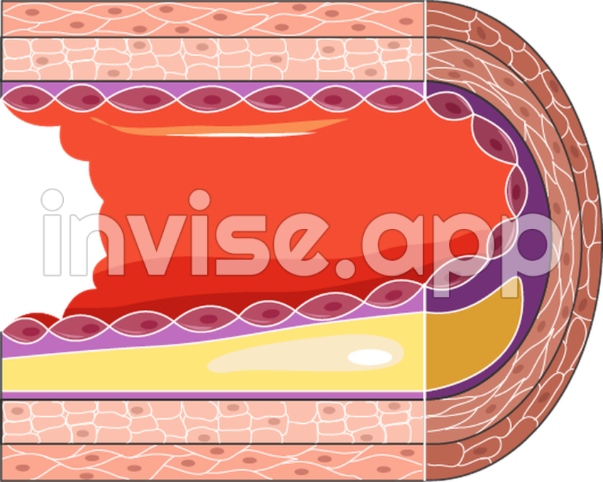 Placa De Ateroma - Atheroma Servier Medical Art