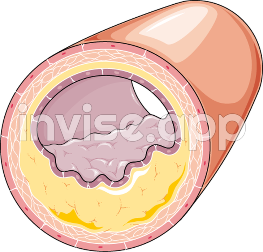 Atheroma Servier Medical Art - Placa De Ateroma